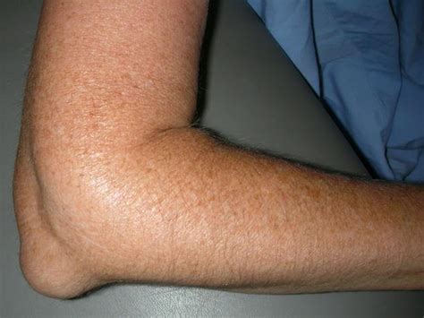 Elbow Contusion Treatment Human Body Anatomy