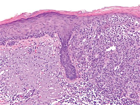 Actinic Keratosis As A Marker Of Field Cancerization In Excision