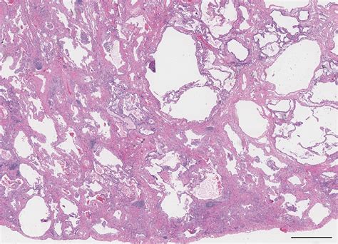 Unclassifiable Interstitial Lung Disease A Pathologists Perspective