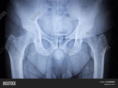 X Ray Orthopedic Scan Image And Photo Free Trial Bigstock