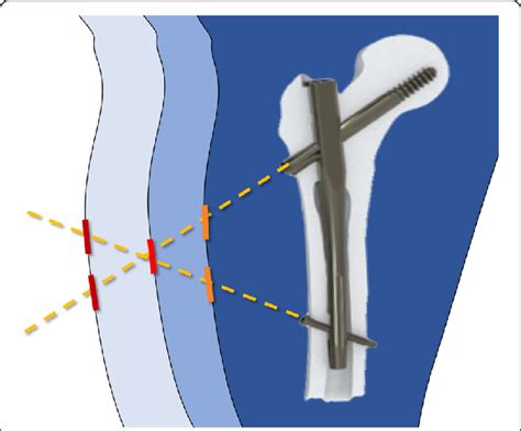 The Cephalic And The Distal Locking Screws Of The Elos® Nail Can Often