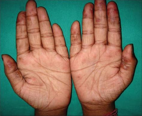 Chilblains Pernio And Chilblain Lupus Erythematosus Causes And Treatment