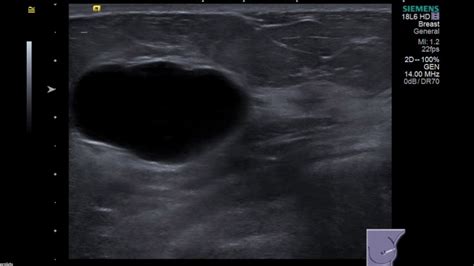 Breast Ultrasound Cyst Youtube