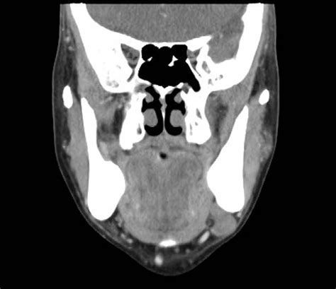 A 22Â 15 Â 22 Cm Enlarged Lymph Node At The Level Ib Of The Left