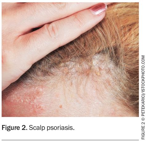 Psoriasis Presentation Types And Management Medicine Today