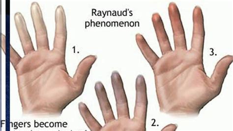 Sindrome Di Raynaud