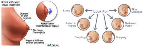 Read complete answer here.also asked, is breast dimpling always cancer? Symtoms & Signs - Breast Cancer