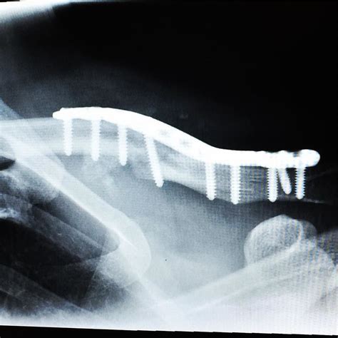 After 11 Months Finally Got My Nonunion Clavicle Fracture Surgery This