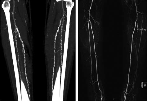 Multimodality Imaging Of Lower Extremity Peripheral Arterial Disease