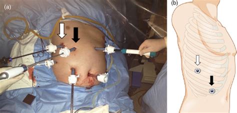 Role Of Intercostal Trocars On Laparoscopic Liver Resection For Tumors