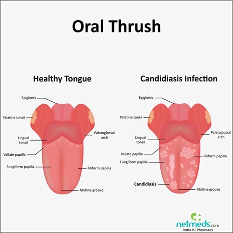 Home Remedies For Oral Thrush Online Discount Save 57 Jlcatjgobmx