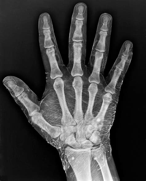 x rays were discovered by wilhelm conrad roentgen on november 8 1895 since the initial