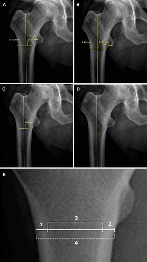 Examples Of Ap Plain Radiographic Images Of The Hip Joint With Manual
