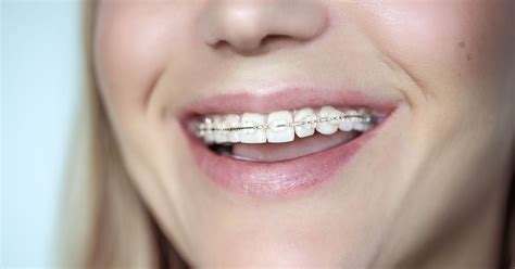 Clear Or Invisible Braces What They Are And Types 🦷