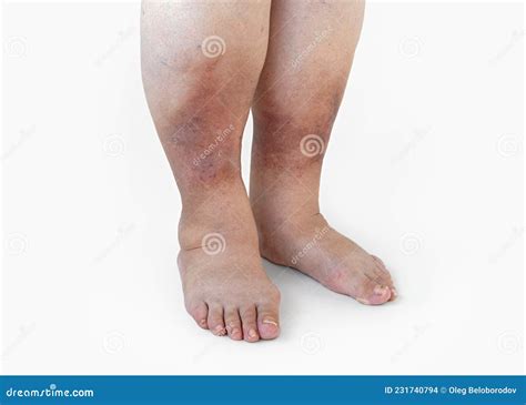 Inflamed Legs Of A Woman With Diabetes Close Up Stock Photo Image Of