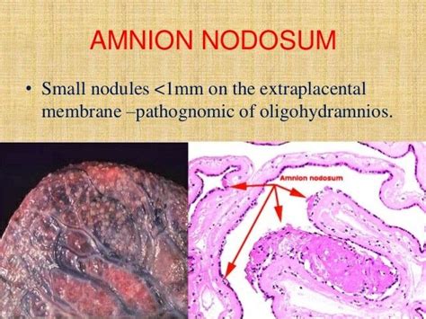 Amnion Nodosum Oligohydramnios Beef Food The Originals