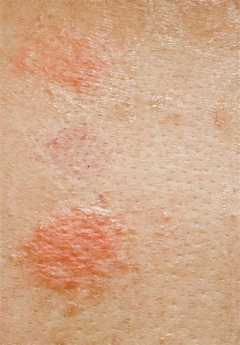 What Are The Most Common Causes Of Circular Rashes