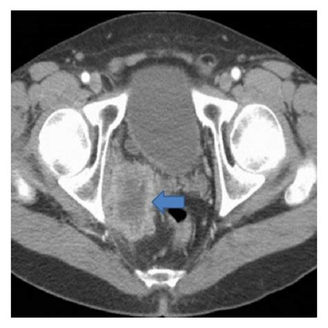 Contrast Enhanced Ct Scan Of The Pelvis Demonstrates A 65 × 51 Cm