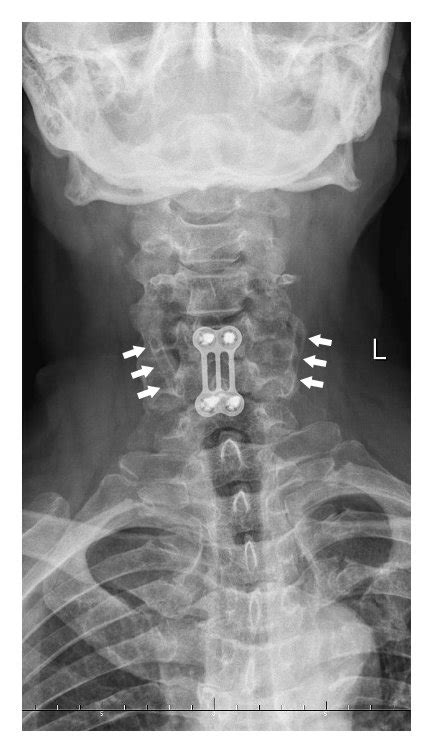 Radiograph Of The Cervical Column Showing Bilateral Cervical Ribs