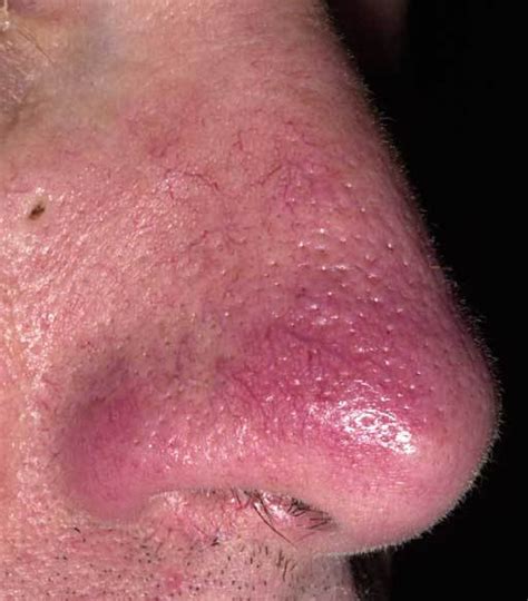 Rosacea Nose Pictures Pictures Photos