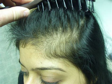 The Hair Loss Centre Female Hair Loss Treated Before And After Photos
