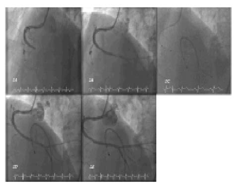 Baseline Right Coronary Angiogram From Second Case Illustrated Large
