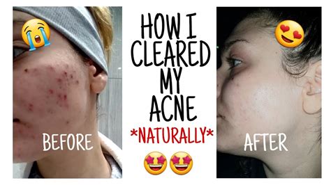 How I Cleared My Acne Naturally Youtube