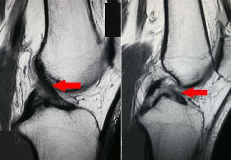 Acl And Knee Ligament Injuries Part 1 The Early Phase