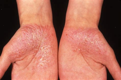 Recognizing And Managing Flares In Generalized Pustular Psoriasis