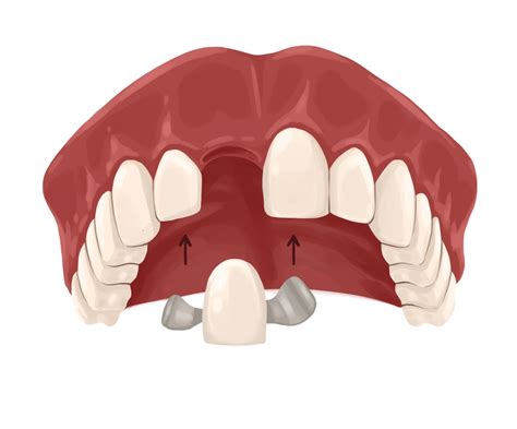 Dental Bridge Types And Procedure Authority Dental