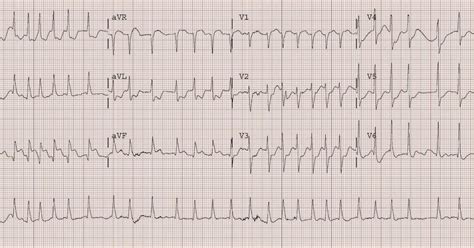 Dr Smith S Ecg Blog Atrial Fibrillation With Rapid Ventricular