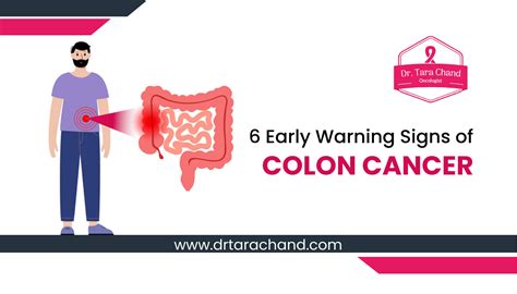 Early Warning Signs Of Colon Cancer In Signs Of Colon Cancer