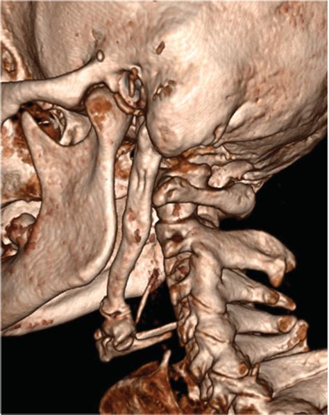 Elongated Left Styloid Process Completely Calcified Stylohyoid