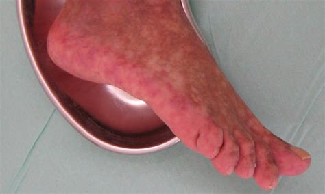 Red Spots On Foot