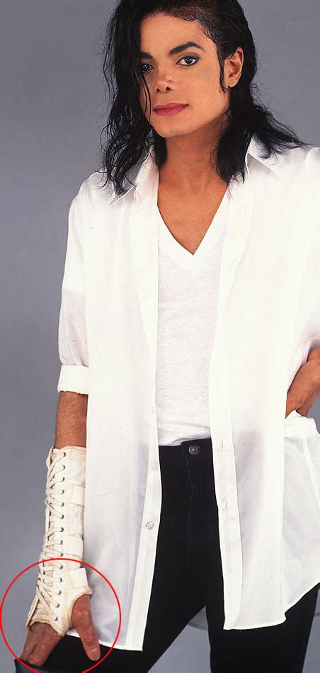 Michael Jackson Vitiligo Liatyris