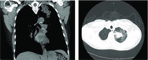 Ct Chest Without Iv Contrast Coronal And Transversal Views Download