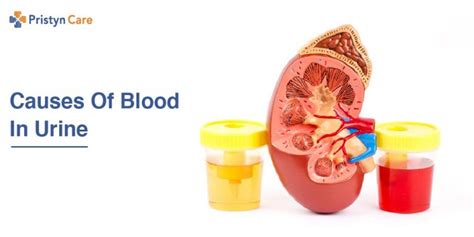 Causes Of Blood In Urine Pristyn Care