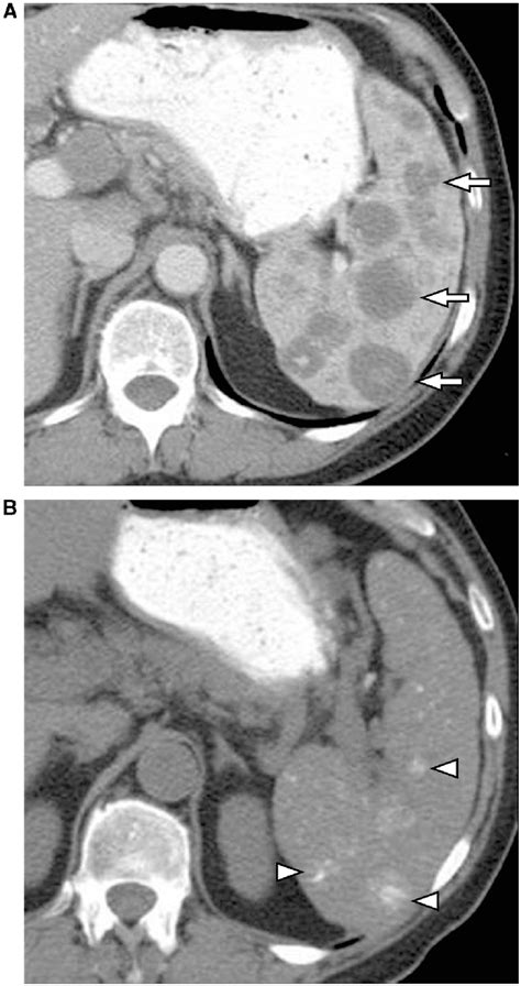 Calcification In The Spleen Following Treatment For Lymphoma A