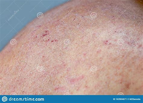 Atocpic Dermatitis Symptoms On The Right Shoulder Stock Image Image