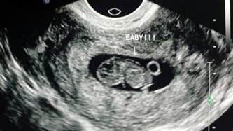 8 Week 5 Day Ultrasound Normal Babycenter