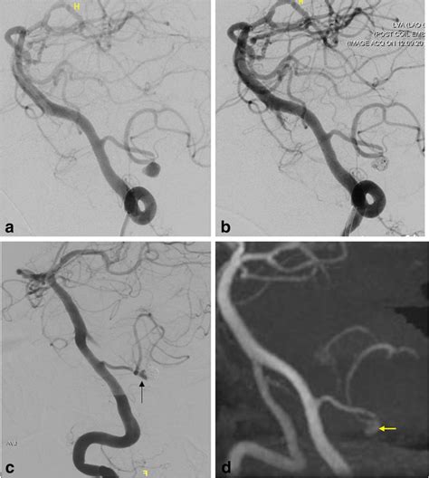 73 Year Old Female Case 2 Angiography A Shows A Typical Dissecting