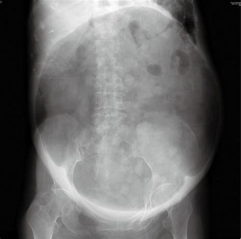 A Giant Gas Filled Abdominal Mass In An Elderly Female A Case Report