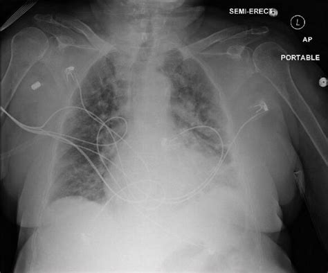 Chest X Ray Reveals Acute Onset Of New Pulmonary Vascular Congestion