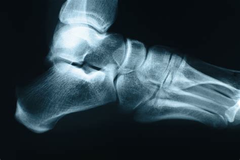 Foot Xray Foundation For Orthopaedic Research And Education Fore