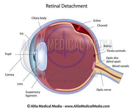 Alila Medical Media Eye Retinal Detachment Labeled Diagram Medical