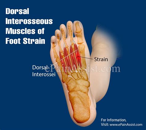 Dorsal Interosseous Muscles Of Foot Strain Treatment Recovery Muscle