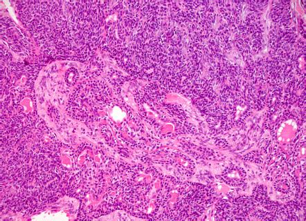 Basal Cell Adenoma Salivary Gland Image Radiopaedia Org