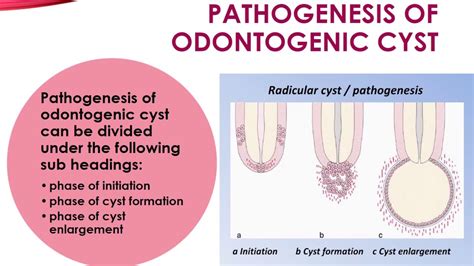 Pathogenesis Of Odontogenic Cyst Youtube