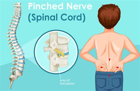 8 Common Symptoms Of A Pinched Nerve And How It Feels Easy Posture