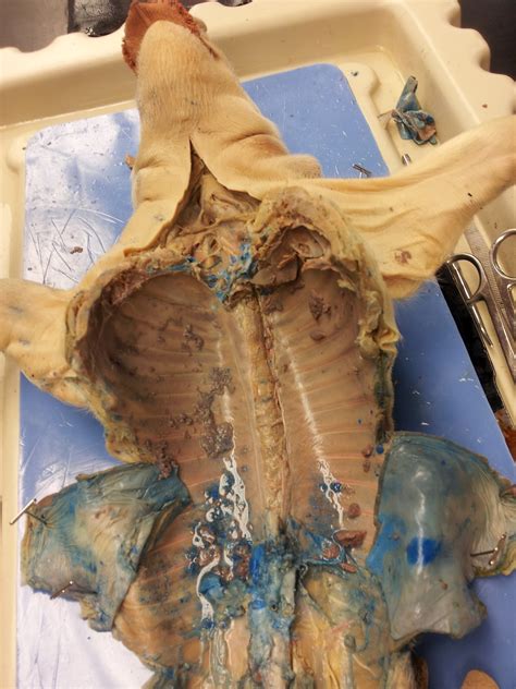 They are located just below the rib cage, one on each side of your spine. Pig Destroyer